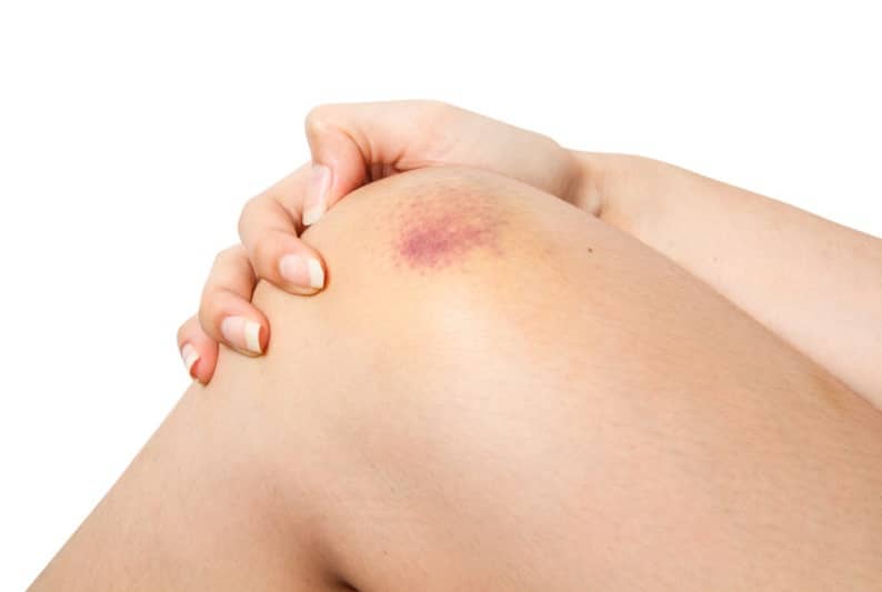 Blessures musculaires : contusions